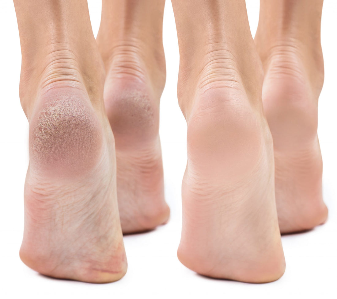 Understanding Dry and Cracked Feet: Causes and Solutions